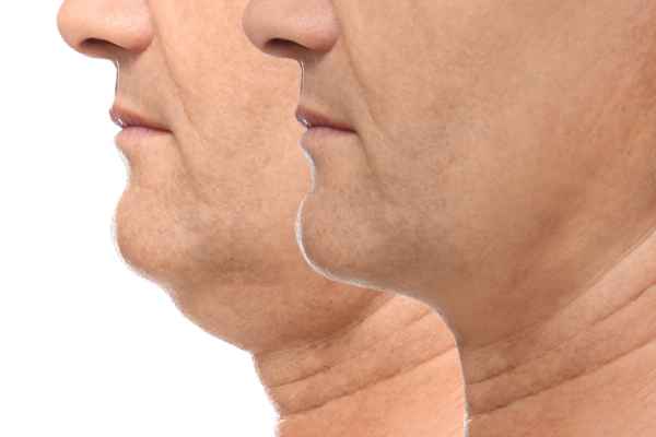 HIFU - Breakthrough in Anti - ageing 2 hifu results Ashford