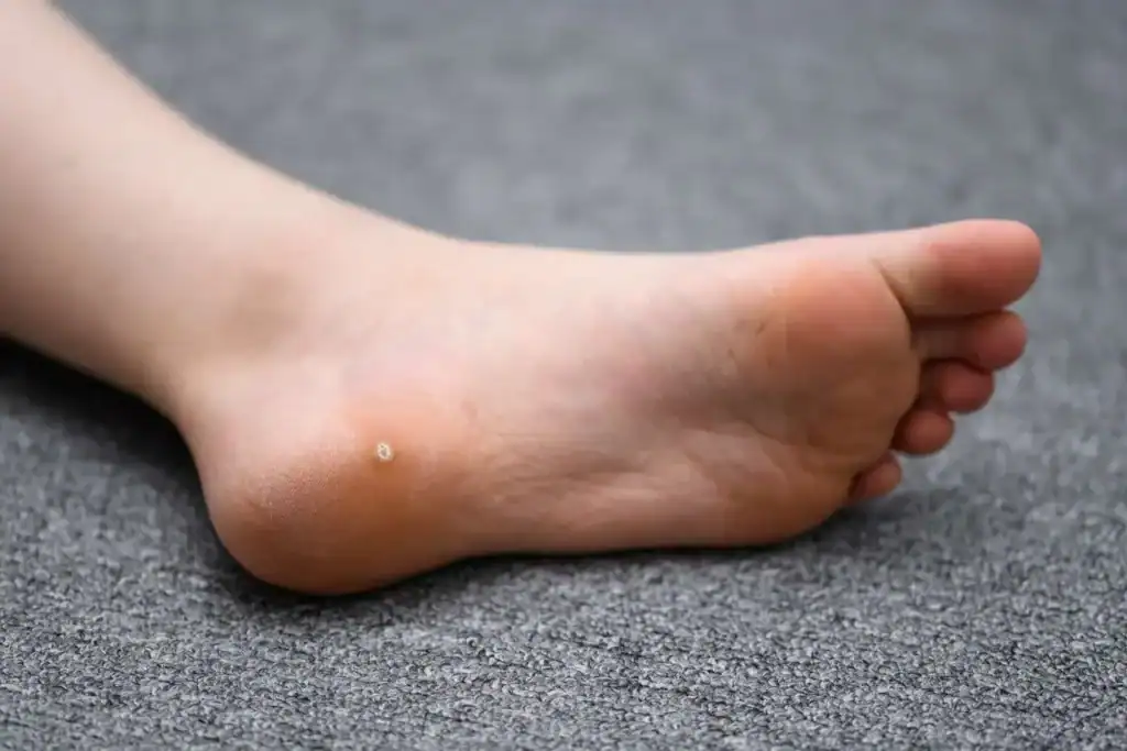 Cryotherapy For Warts And Also Verrucas 2 Image of verruca on the bottom of the foot that able to be treated with Cryotherapy Ashford