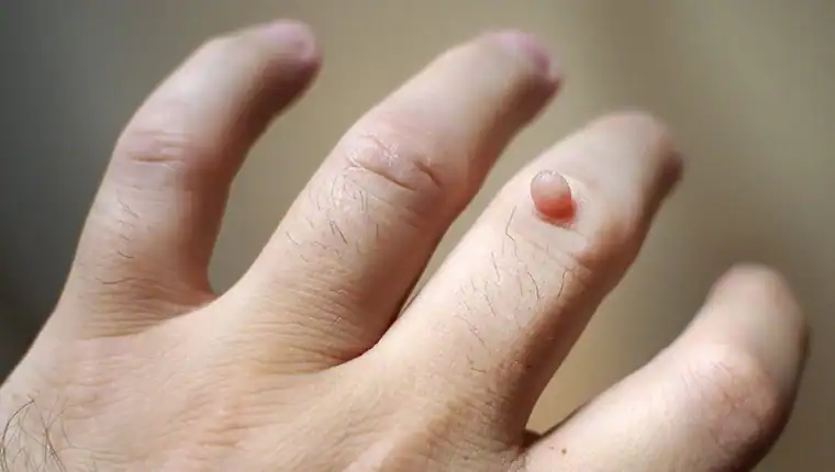 Image of blemish that Cryotherapy Ashford can remove with Lipo 360.