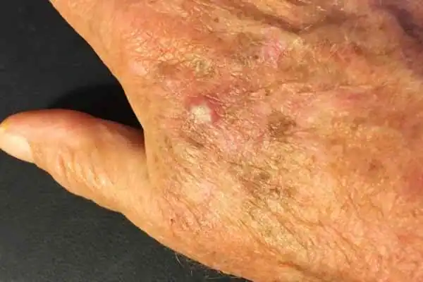 Cryopen For Actinic Keratoses 1 Image of Actinic keratoses Ashford on a person hand