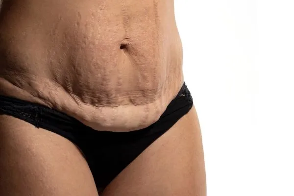 The science behind skin tightening Ashford picture of a woman's sagging skin on the stomach